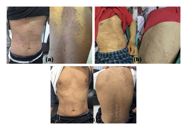 G-MSC輸注對一名有5年嚴重斑塊狀銀屑病病史的19歲男性的影響。