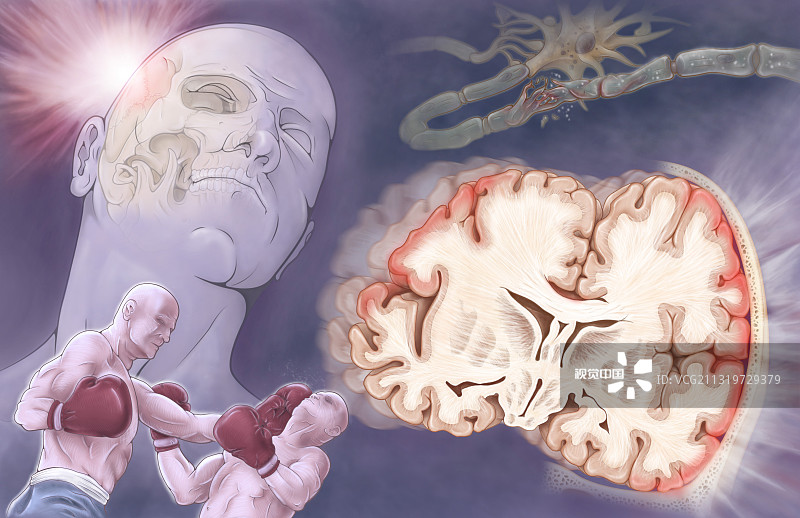 間充質(zhì)干細胞治療創(chuàng  )傷性腦損傷的臨床進(jìn)展