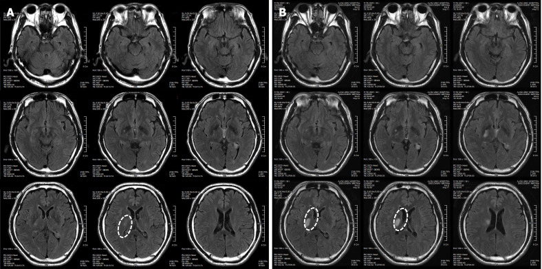 圖1：微創(chuàng  )人臍帶間充質(zhì)干細胞移植前患者的腦部計算機斷層掃描圖像。
