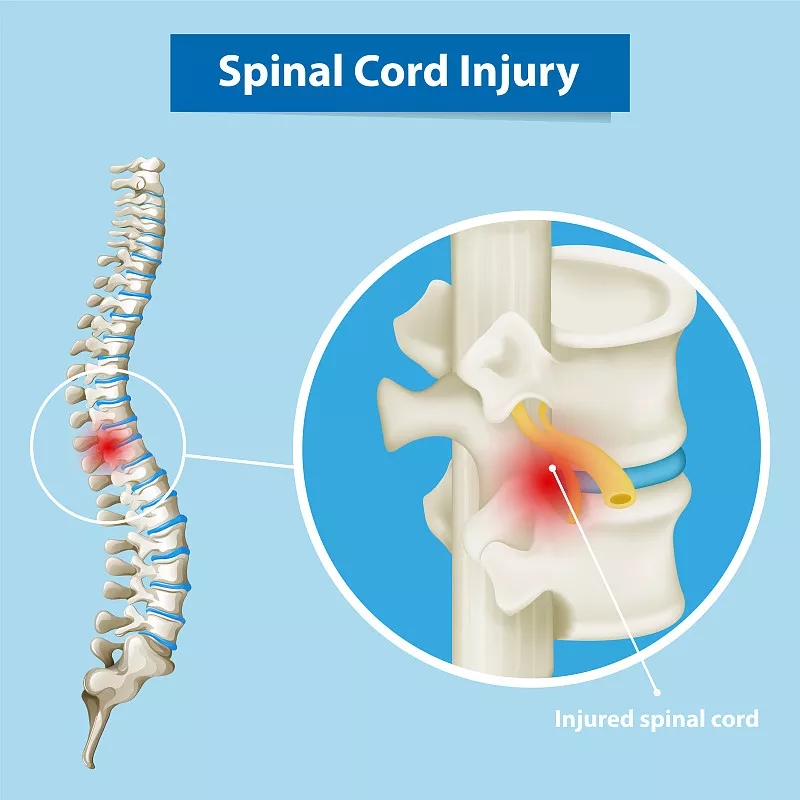 神經(jīng)干/祖細胞移植治療慢性脊髓損傷的臨床研究進(jìn)展 神經(jīng)干/祖細胞移植治療慢性脊髓損傷的臨床研究進(jìn)展