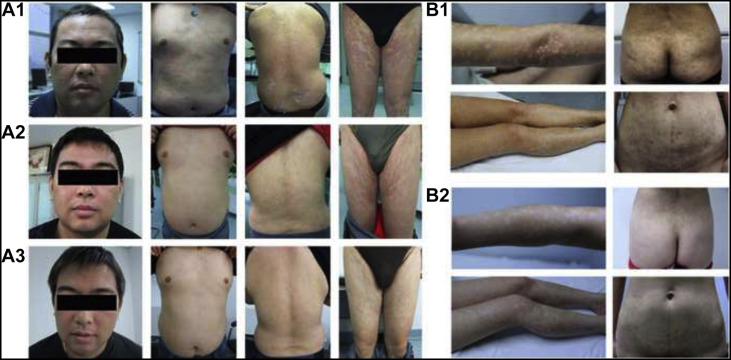 間充質(zhì)干細胞治療銀屑病的臨床案例