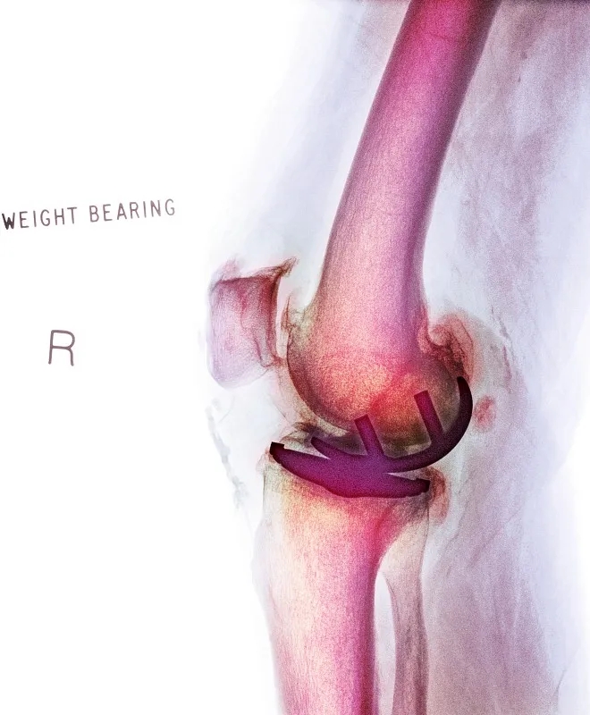 關(guān)節內移植干細胞治療膝骨關(guān)節炎:一項IIb期臨床試驗