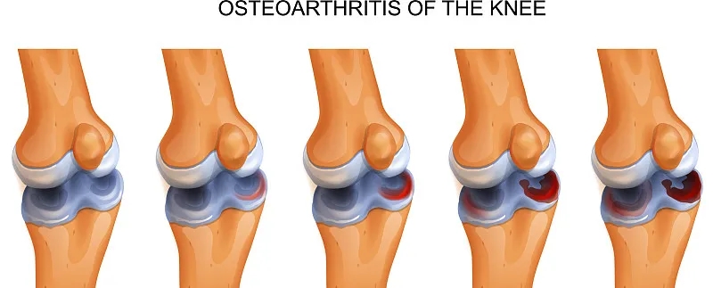 干細胞修復撕裂的無(wú)血管半月板軟骨：從體外優(yōu)化到首次人體研究