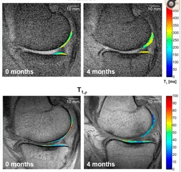 干細胞療法修復后疼痛顯著(zhù)減輕，半月板軟骨質(zhì)量提高。