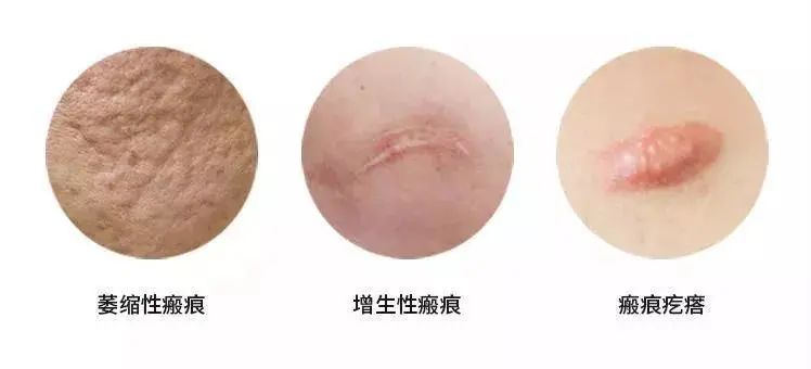 根據瘢痕的顏色、質(zhì)地和形態(tài)，臨床可以將瘢痕分為三大類(lèi)：萎縮性瘢痕、增生性瘢痕和瘢痕疙瘩。