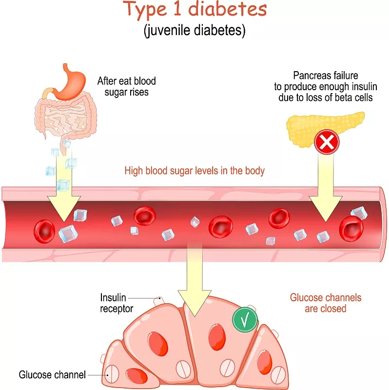 1型糖尿病癥狀有哪些？