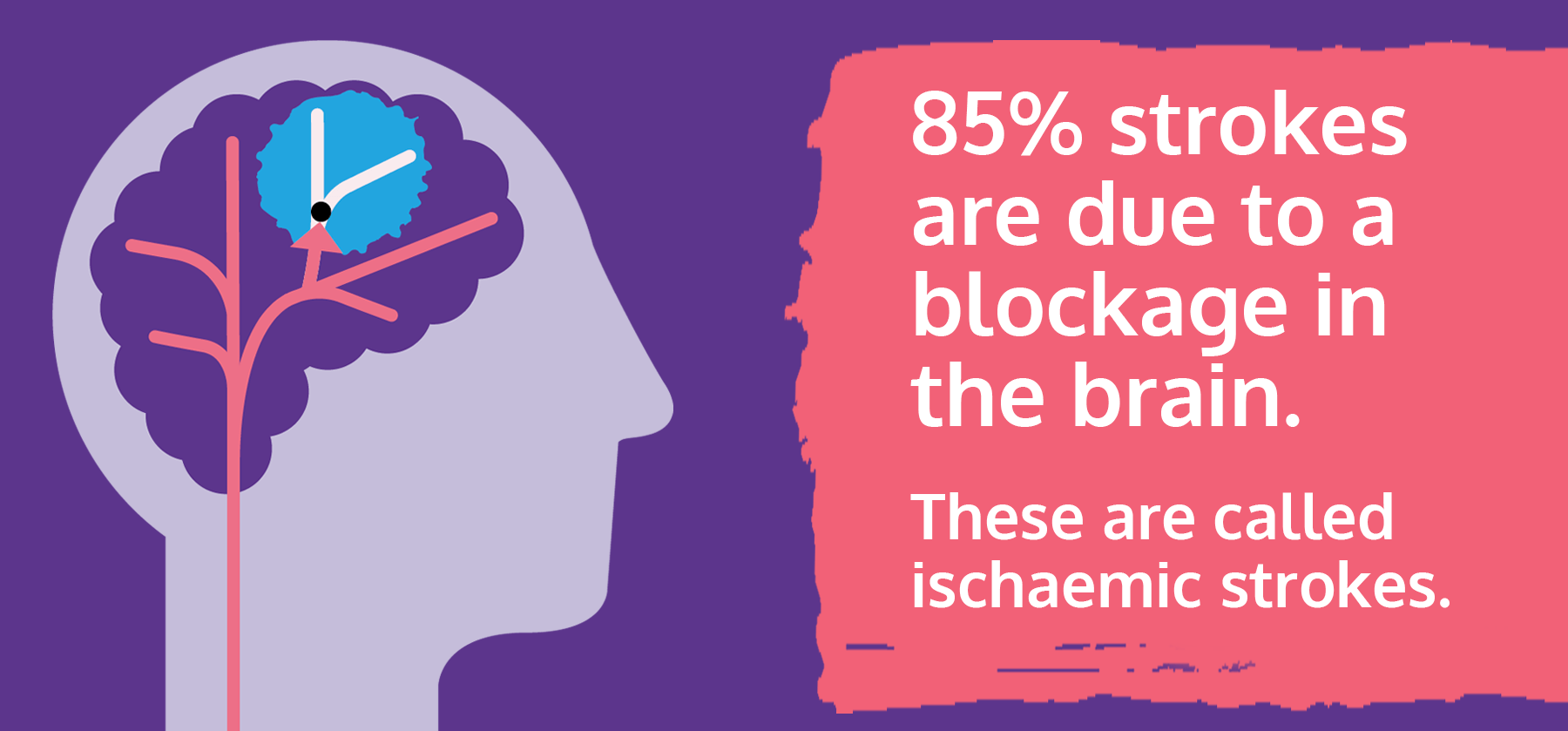 什么是缺血性中風(fēng)