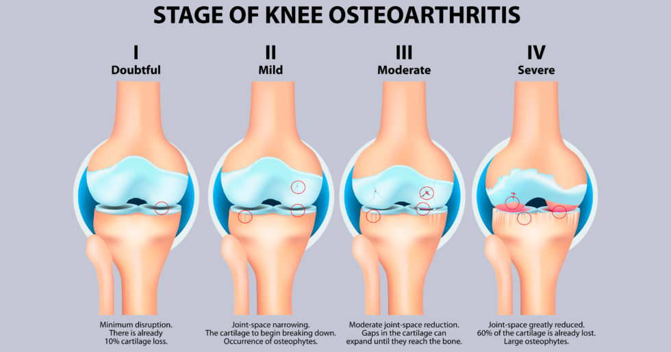 骨關(guān)節炎癥狀有哪些 骨關(guān)節炎癥狀有哪些