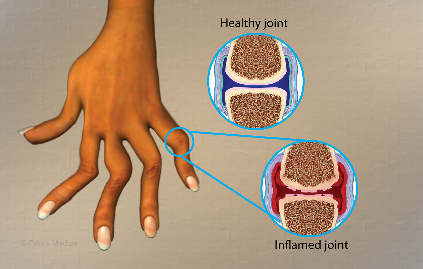 類(lèi)風(fēng)濕關(guān)節炎是什么病