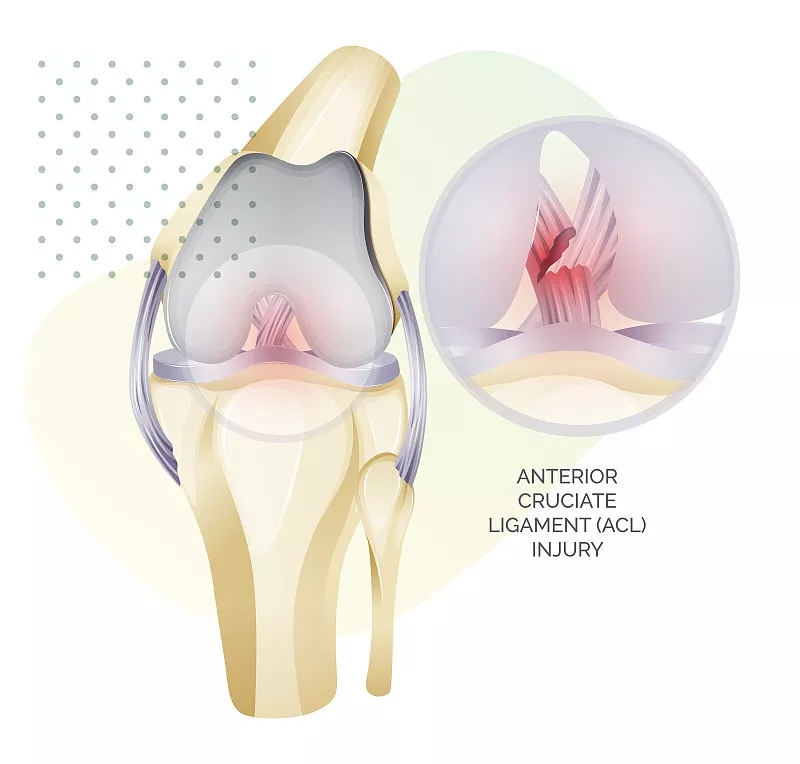 干細胞療法對半月板損傷的益處