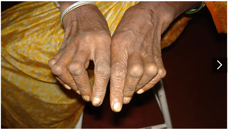 類(lèi)風(fēng)濕關(guān)節炎癥狀