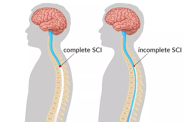 不完整和完整的脊髓損傷有什么區別