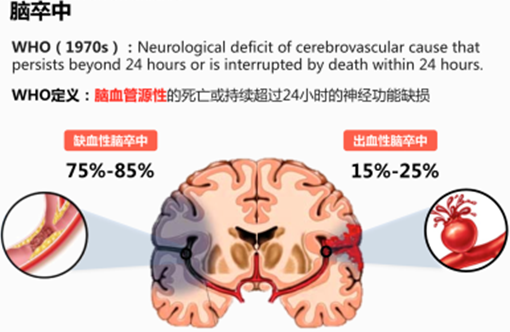 干細胞治療缺血性腦卒中的效果跟給藥途徑有關(guān)嗎 干細胞治療缺血性腦卒中的效果跟給藥途徑有關(guān)嗎
