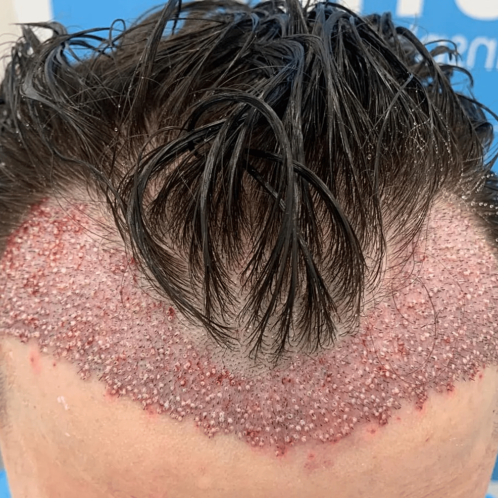 頭發(fā)移植手術(shù)后即刻的結果?！@允許在患者中建立更豐滿(mǎn)和更前的發(fā)際線(xiàn)