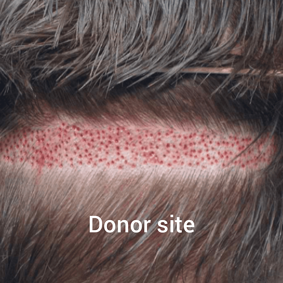 新技術(shù)的供體現場(chǎng)收獲試圖減少后部頭皮疤痕