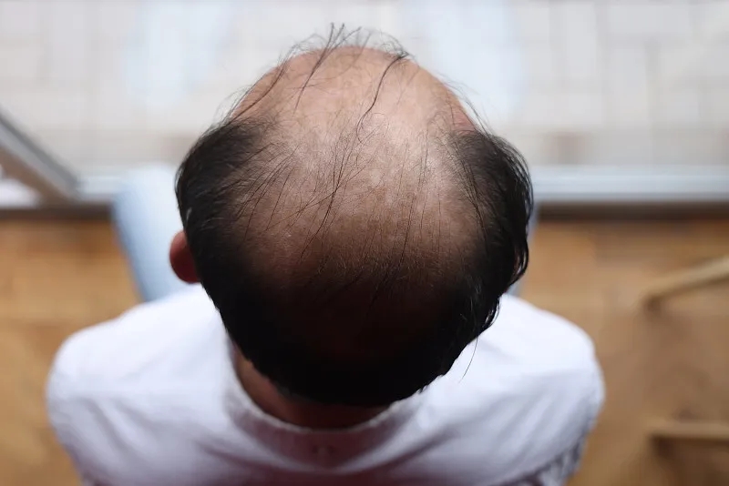 干細胞治療脫發(fā)的優(yōu)缺點(diǎn) 干細胞治療脫發(fā)的優(yōu)缺點(diǎn)