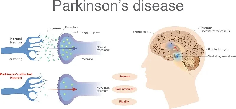 什么是帕金森病的再生醫學(xué)