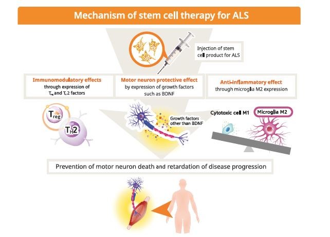 干細胞療法用于治療肌萎縮側索硬化癥（ALS）。