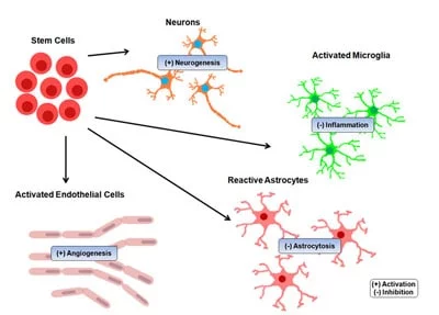 干細胞治療中風(fēng)的結果