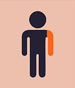 單癱型腦癱影響一側肢體，通常是手臂。