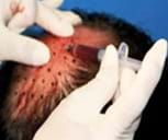 毛囊周?chē)? class=