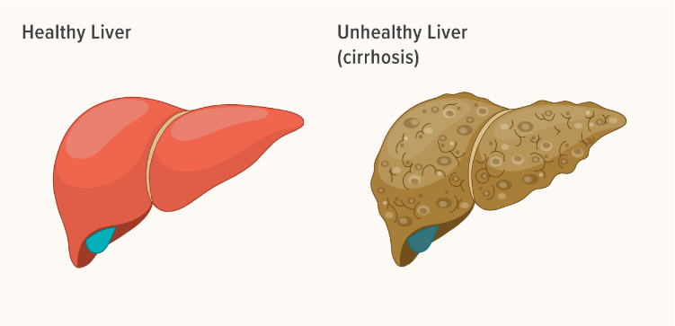 導致肝臟疾病的問(wèn)題及其原因 導致肝臟疾病的問(wèn)題及其原因