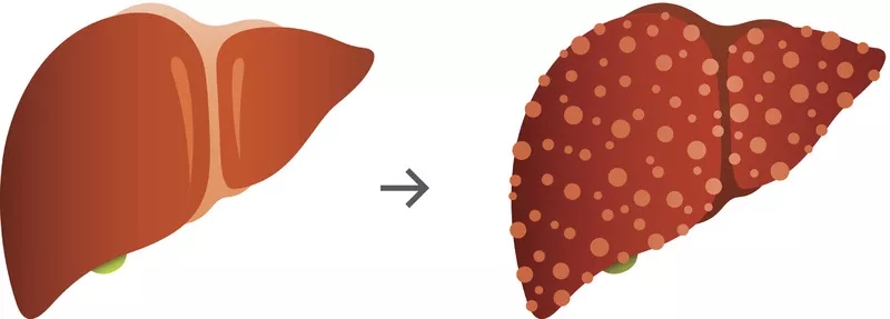 肝硬化的體征和癥狀是什么？及其治療方法