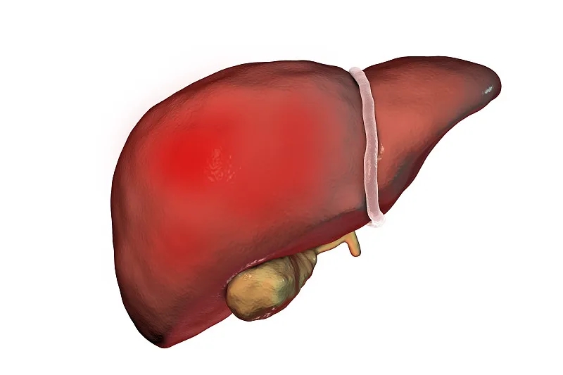 什么是丁型肝炎？