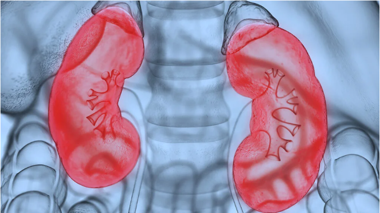 什么是腎病綜合征？癥狀和治療