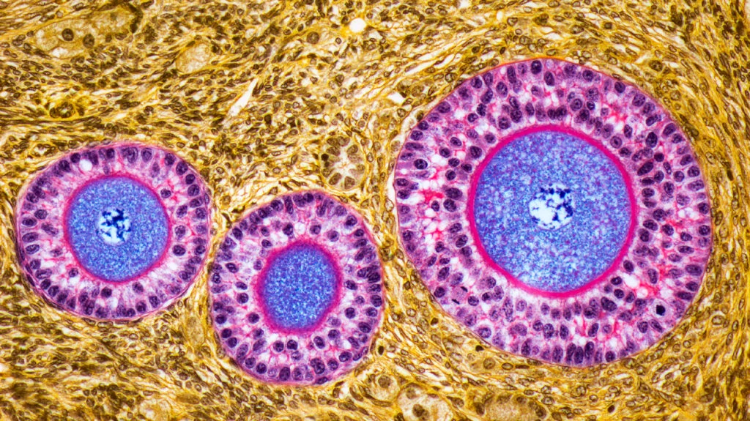 卵巢早衰體征和癥狀是什么？及其治療方法