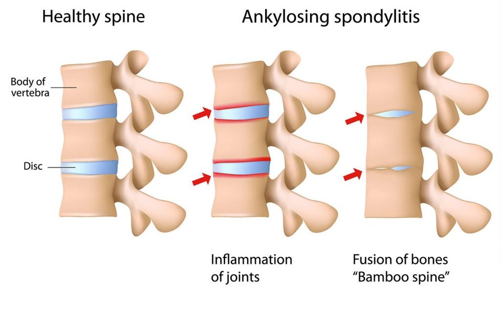 間充質(zhì)干細胞療法與強直性脊柱炎：一種新的治療方法