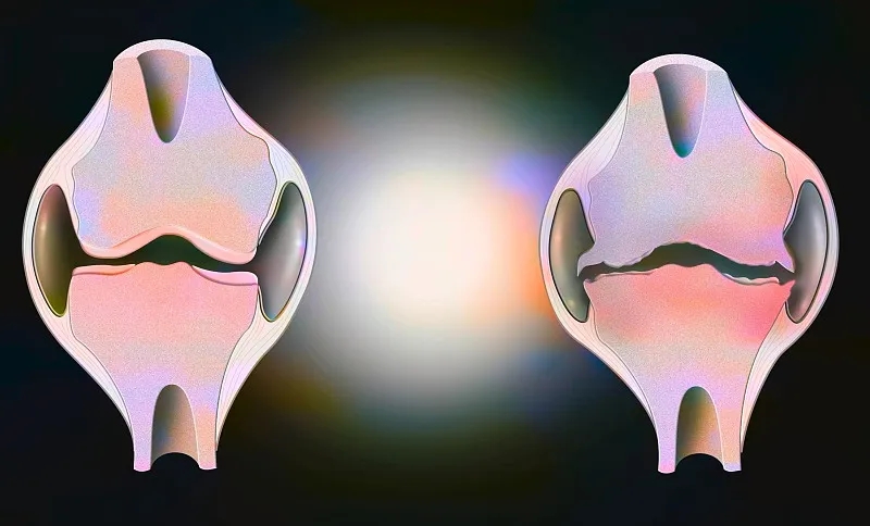 盤(pán)點(diǎn)：2020~2023年干細胞治療骨關(guān)節炎的臨床研究進(jìn)展