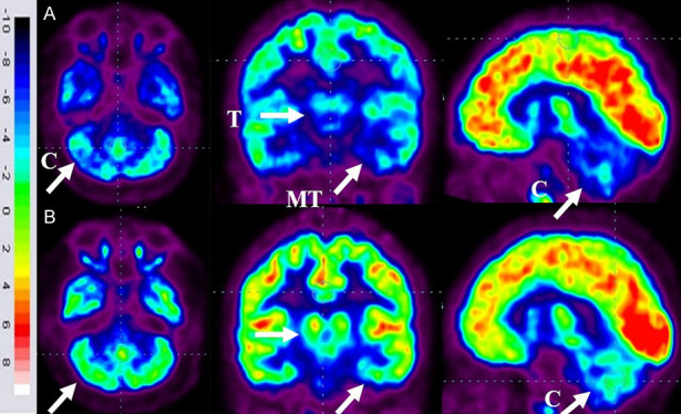 圖6：ASD患者在細胞治療前和細胞治療后6個(gè)月進(jìn)行的FDG-PET/CT大腦掃描的代表性圖像。