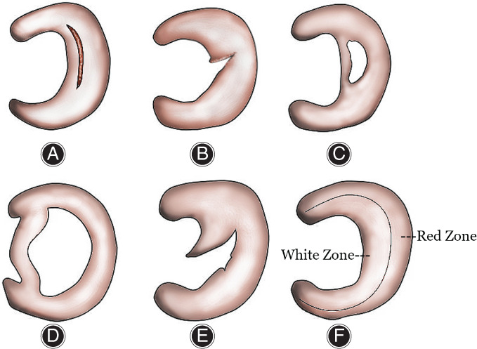 圖2：半月板的解剖結構和損傷類(lèi)型