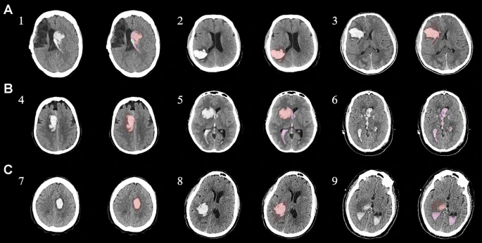 圖1：每個(gè)間充質(zhì)干細胞治療患者按組的原始非對比計算機斷層掃描和分割結果