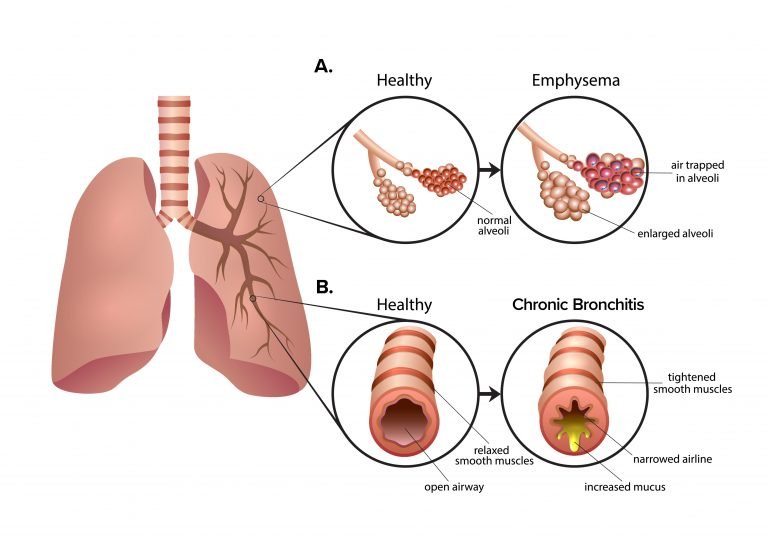 圖2：慢性阻塞性肺疾病 (COPD) 是一組導致呼吸困難的肺部疾病。A.肺氣腫導致肺泡氣囊受損和僵硬?？諝獗焕г诜闻葜?，導致呼氣困難。B.慢性支氣管炎會(huì )導致氣道腫脹和粘液增多。多余的粘液使呼吸困難并導致慢性咳嗽