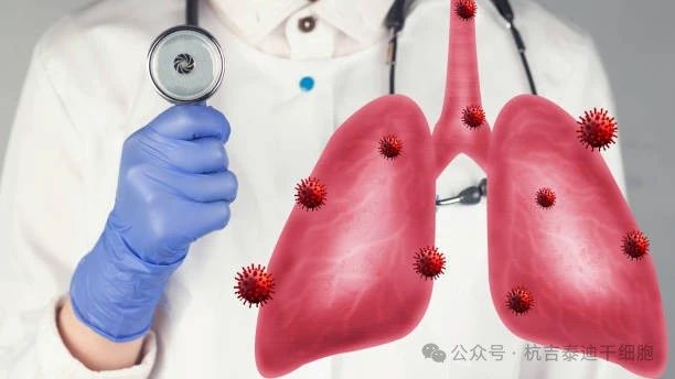 干細胞療法如何減緩肺部疾病的癥狀？