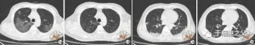 細胞輸注后，炎癥指標改善，復查胸部CT提示雙肺病灶較前吸收，呼吸道癥狀改善，新型冠狀病毒核酸檢測連續2次陰性，治愈出院。