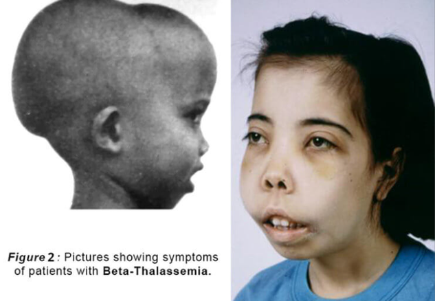 重型β地中海貧血是一種嚴重的遺傳性疾病，給患兒帶來(lái)了長(cháng)期的痛苦和折磨