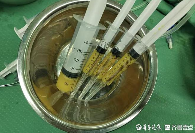 孫濤主任采用的自體脂肪微片段治療術(shù)，為她的治療帶來(lái)了新的轉機