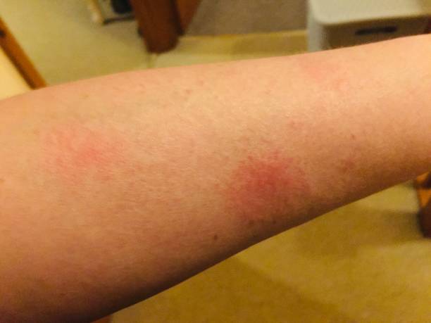 系統性紅斑狼瘡的最佳治療方法是什么？