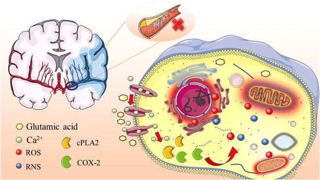 高血壓、高脂血癥、高同型半胱氨酸血癥、高血糖、吸煙和酗酒等危險因素都可能引發(fā)缺血性中風(fēng)的發(fā)生。