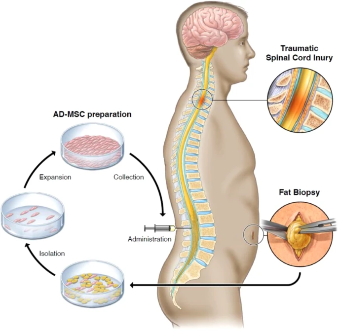 通過(guò)活檢、AD-MSC 分離、擴增和收集以及治療管理來(lái)獲取脂肪的過(guò)程圖解