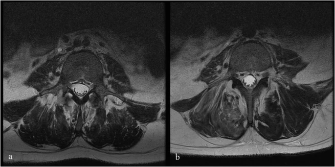 圖1：6號患者輸注前和輸注后MRI。