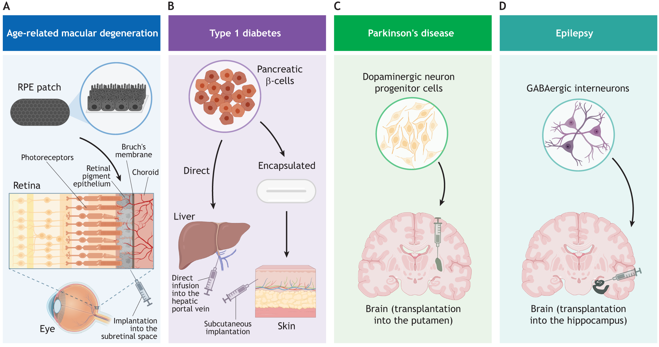 圖2：使用hPSC衍生細胞產(chǎn)品進(jìn)行開(kāi)創(chuàng  )性臨床試驗時(shí)所涉及的細胞類(lèi)型和注射部位的圖示。