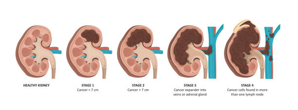 你了解急性腎損傷的3個(gè)不同階段嗎？