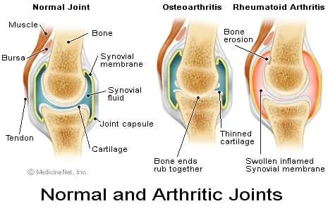 骨關(guān)節炎：你真的了解是什么導致你的關(guān)節痛嗎？