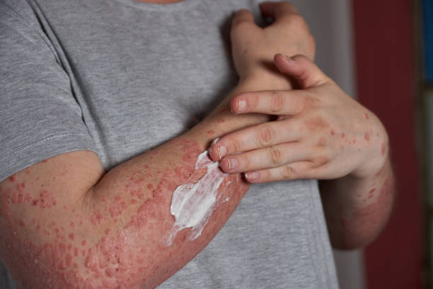 銀屑病的4類(lèi)治療方式和用藥類(lèi)型，你都清楚嗎？