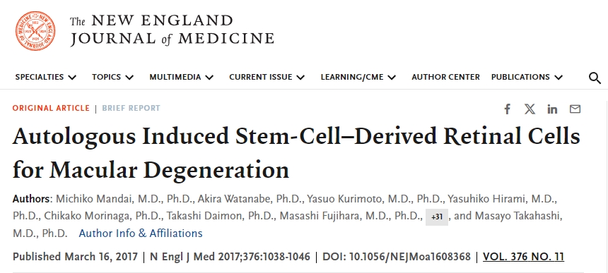 自體誘導干細胞來(lái)源的視網(wǎng)膜細胞用于治療黃斑變性