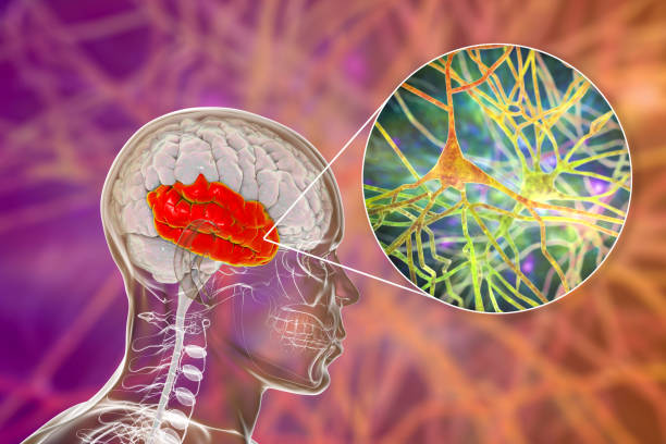 如何治療精神分裂癥？